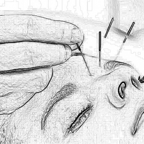 Acupuntura estética é alternativa para aliviar rugas, olheiras e flacidez
